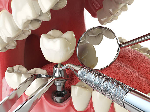 Best Knocked-Out Tooth (Avulsed Tooth) Treatment in South Houston, TX